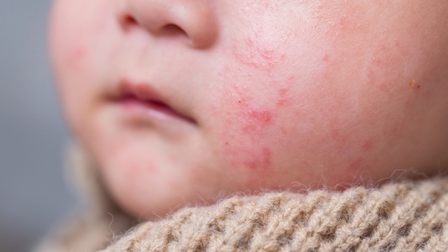 Dete sa ekcemom na licu izbliza